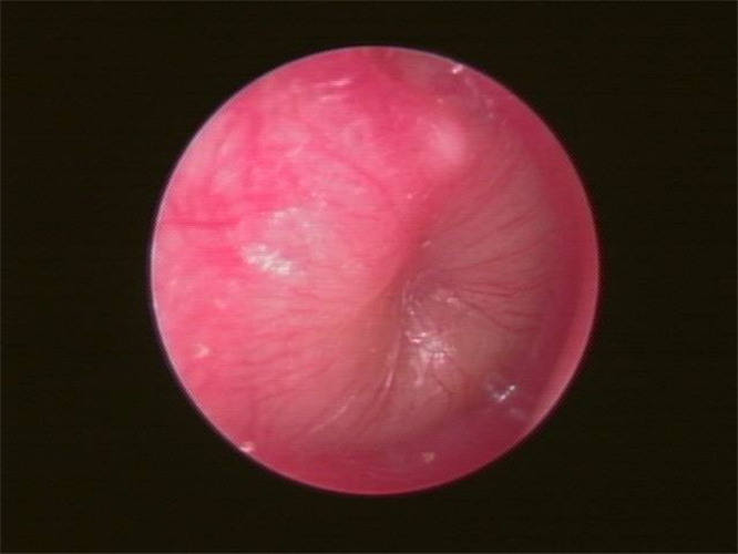 右耳急性中耳炎