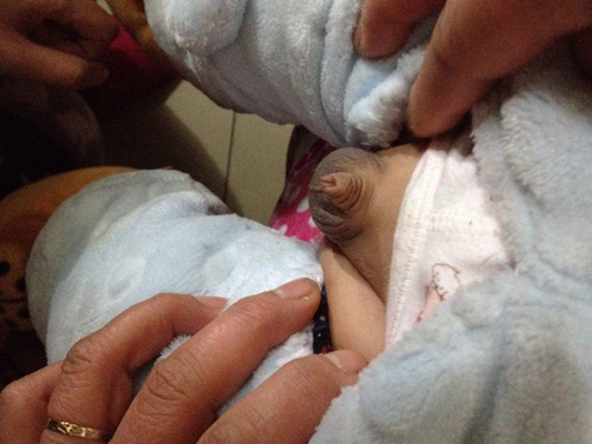 男寶寶疝氣的症狀