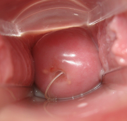 子宮肥大圖 (38) 