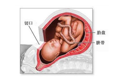 剖腹產手術 (43) 