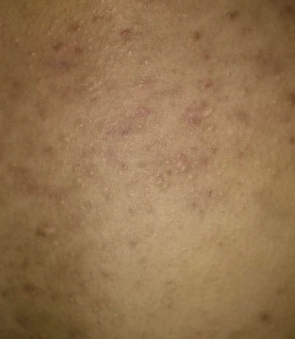 真菌類皮囊炎誘因 