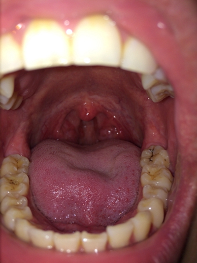 口腔念珠菌感染 (6) 