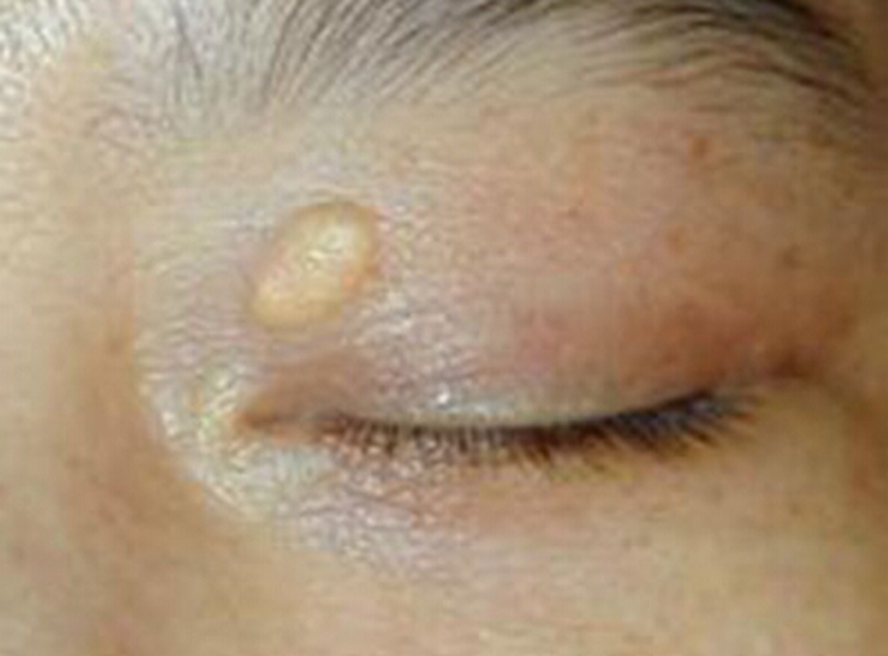 皮膚黃色瘤病早期皮膚症狀