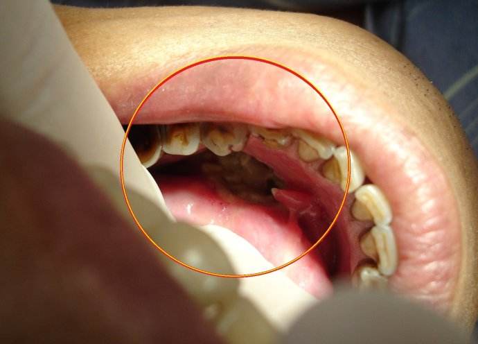 扁桃體癌圖  (68) 