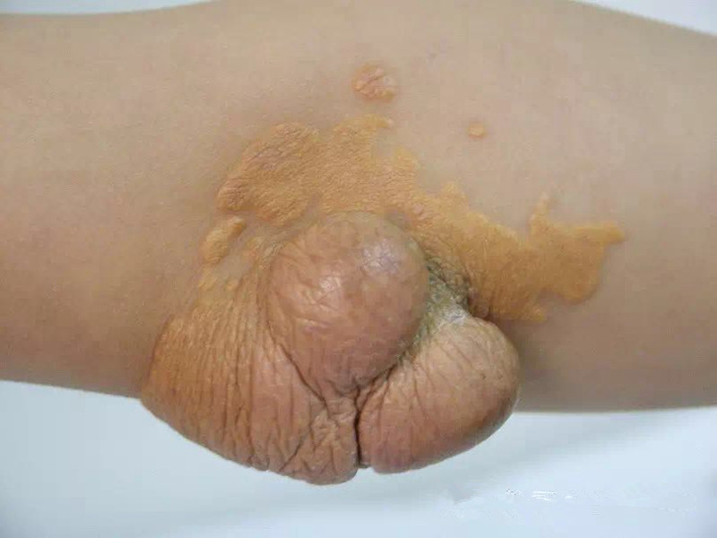 皮膚黃色瘤病瘤體