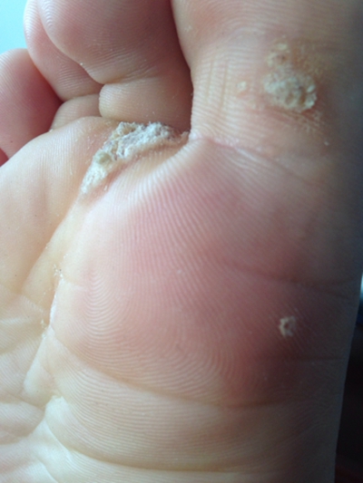 足蘚初期症狀