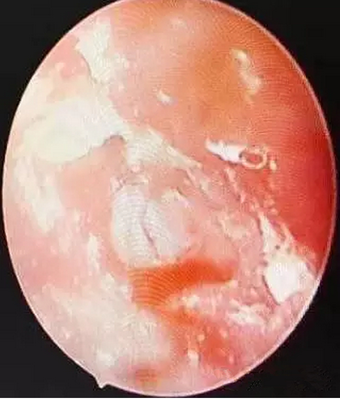 小孩鼓膜穿孔術後