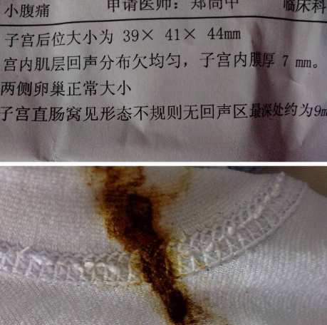 白帶帶有褐色分泌物 (9) 