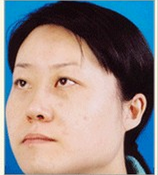 鮮紅斑痣激光後的