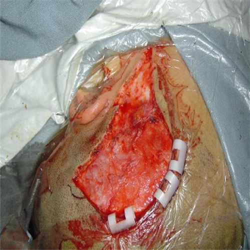 耳後皮脂腺痣切除