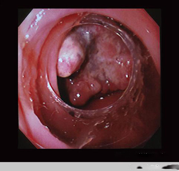 治療腸腫瘤觀察