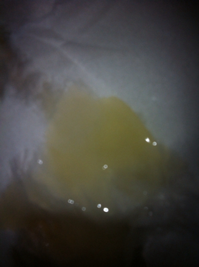 不正常精液液化