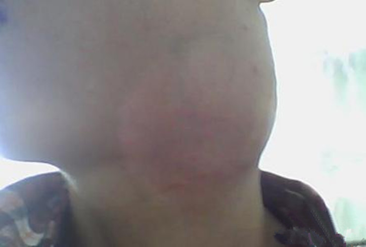 青年淋巴結核頜下的