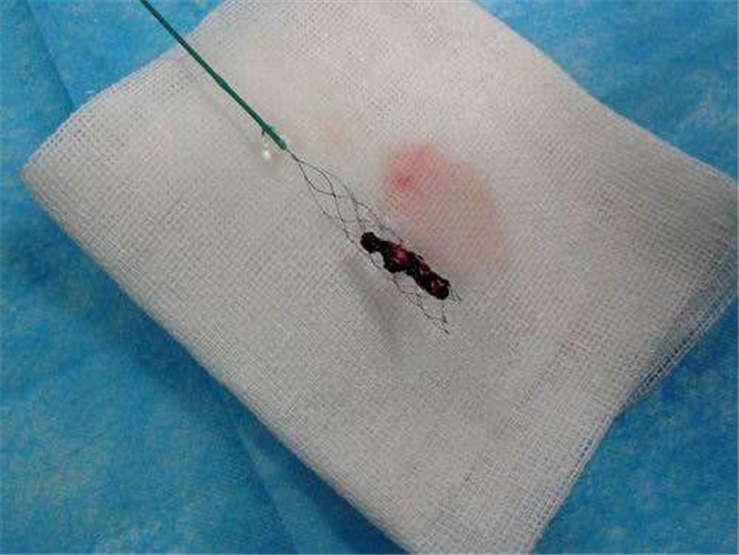 支架取出的腦梗塞血栓