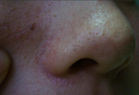 鼻子長蟎蟲症狀