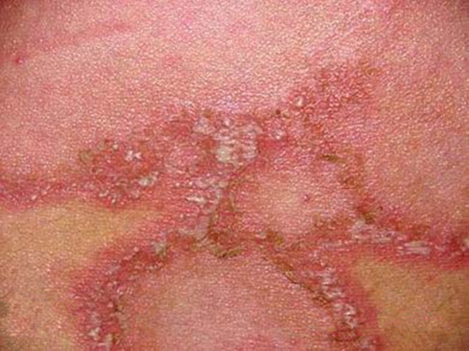 大皰性皮膚病膿皰病