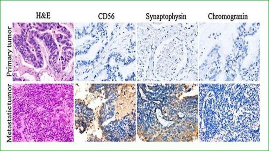 小細胞型肺腺癌