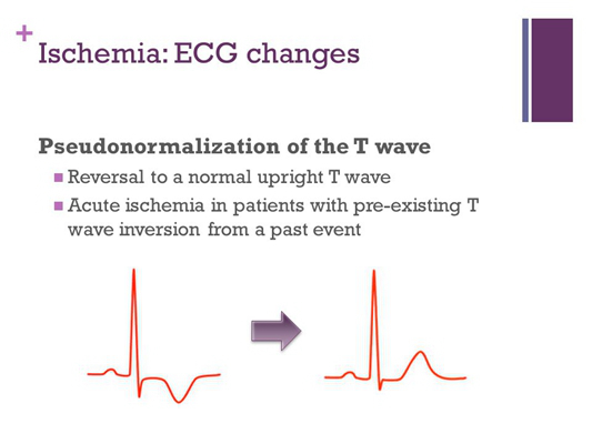 房顫心電圖特點 (6) 