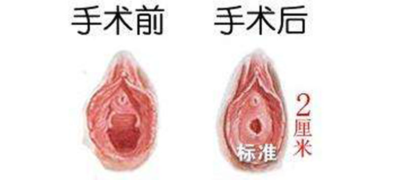處女膜局部脫落圖 