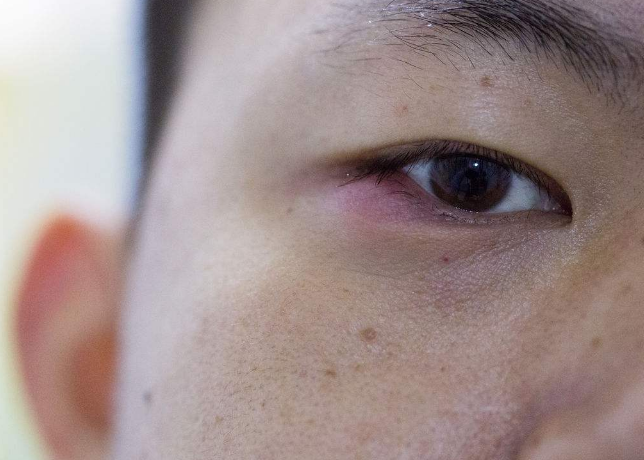 眼睛麥粒腫初期