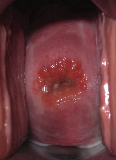 子宮肥大圖 (46) 