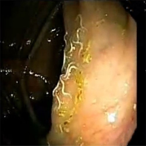 潰瘍性結腸炎誘發寄生蟲