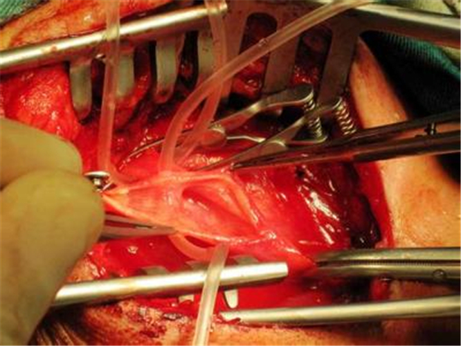 手術治療腦梗塞的