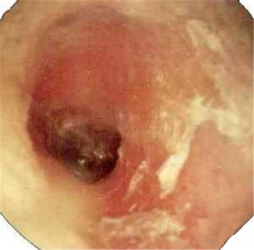 真菌性外耳道炎什麼樣