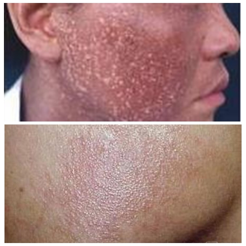 面部皮膚黑變病