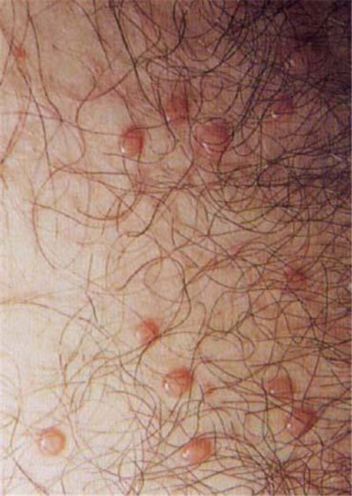 什麼叫傳染性軟疣 