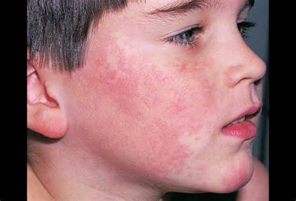 腮腺炎的症狀和