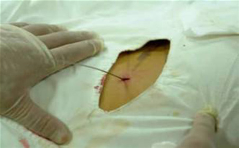 微創治療急性胰腺炎