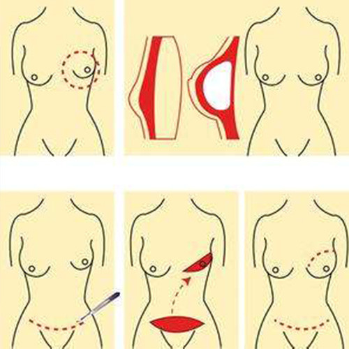 乳腺纖維瘤手術 