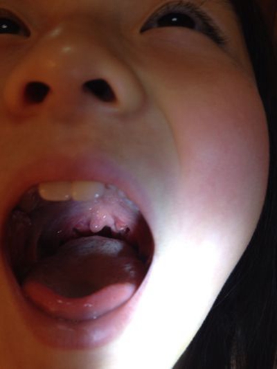 食道炎的症狀圖 (55) 