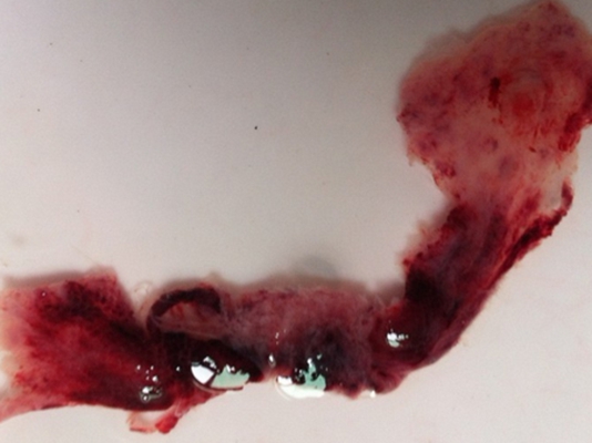 流產掉下來的孕囊