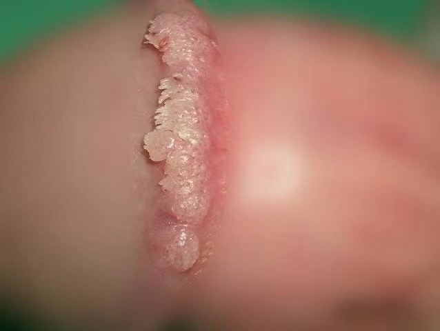 男性尖銳溼疣照片 (37) 