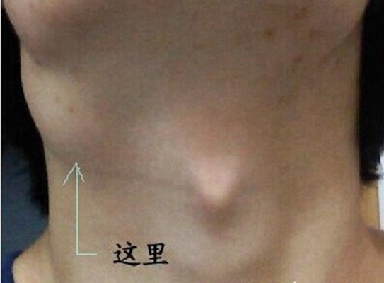 頜下淋巴結腫大