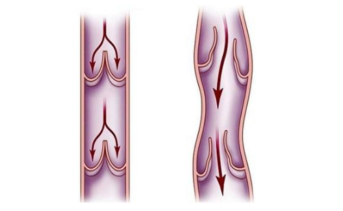 脈管炎早期症狀