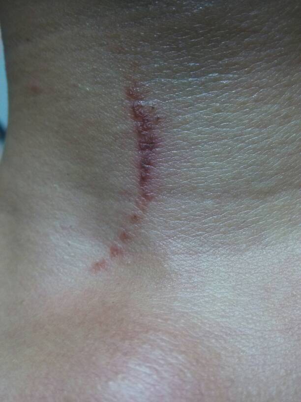 隱翅蟲皮炎結痂