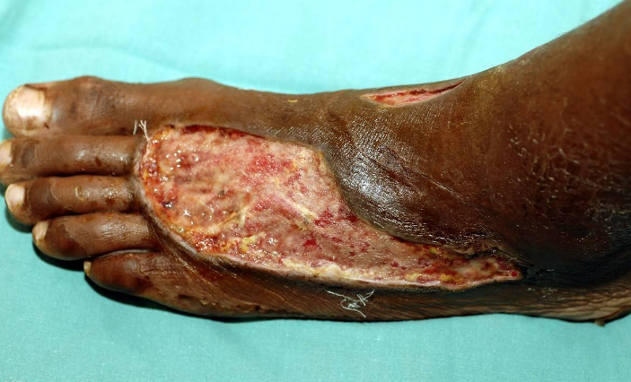 脈管炎早期症狀