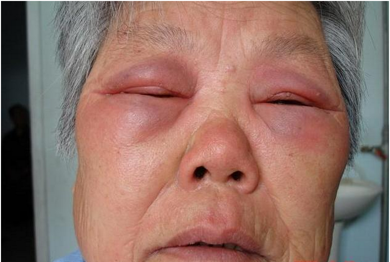 植物日光性皮炎