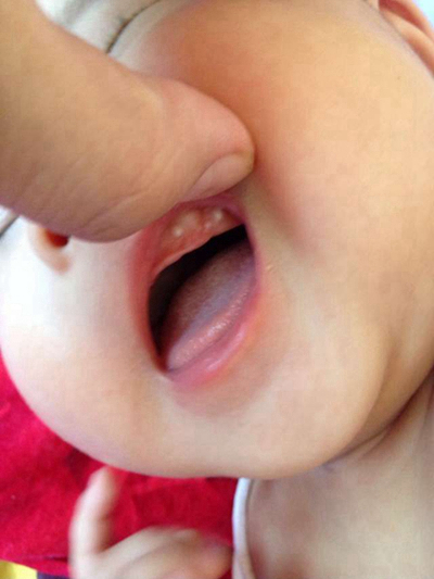 寶寶鵝口瘡 (8) 
