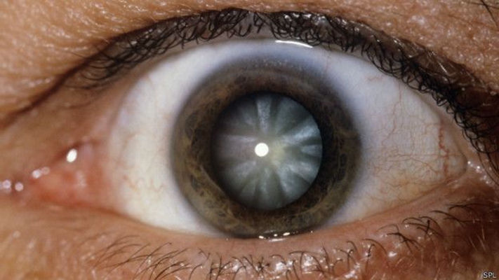 白內障的早期症狀