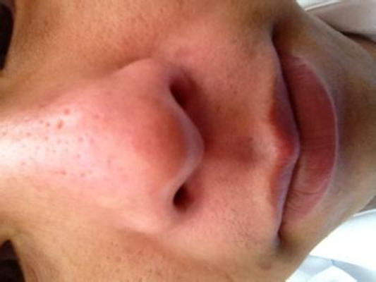 鼻子長蟎蟲症狀