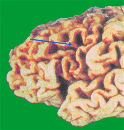 腦供血不足致腦萎縮