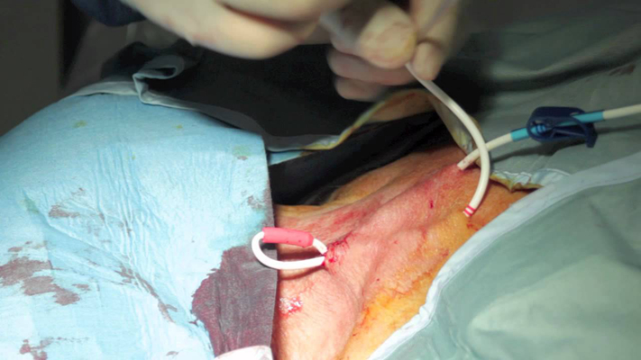 頸靜脈怒張 (39) 