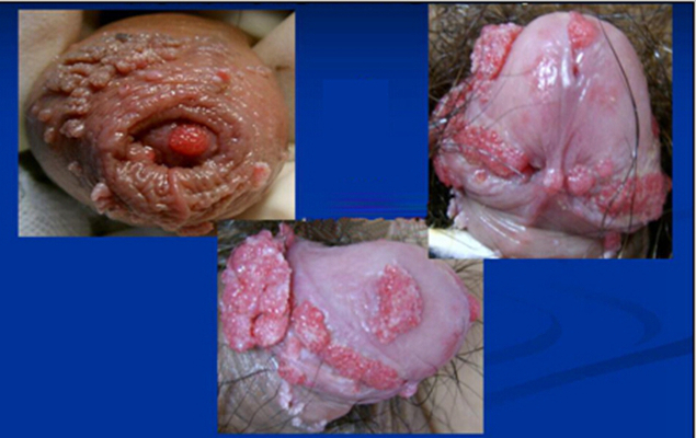 男性尖銳溼疣照片 (7) 