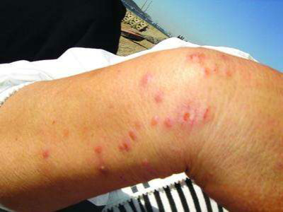 性病性淋巴肉芽腫套圖 (45) 