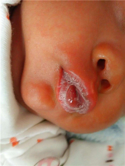 新生兒肺炎吐泡泡 (5) 