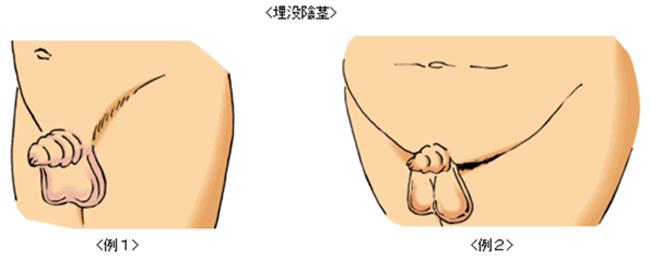 嵌頓包莖鬆解術六歲 